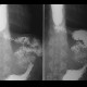 Oesophageo-jejunal anastomosis: RF - Fluoroscopy